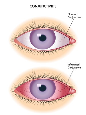 Ayurvedic Eyes Treatment of Allergic Conjunctivitis (Eye All