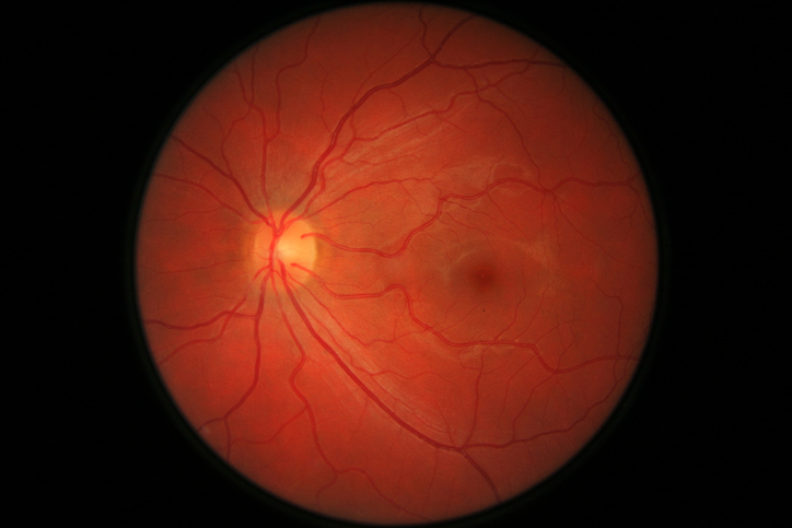 ARMD (Age Related Macular Degeneration) Treatment of Eye.