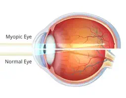 Myopia (Reduing Glassess Number)