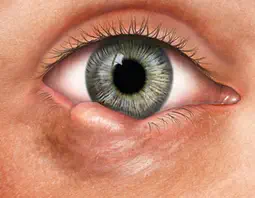 Eye Lids Disease