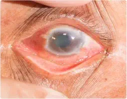 Glaucoma Treatment