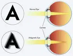 Amblyopia (Lazy Eye)