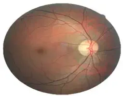 Diabetic Retinopathy