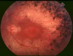 Retinitis Pigmentosa treatment with best doctors