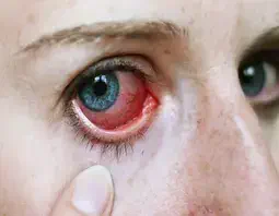 best Uveitis treatment in mandsaur madhya pradesh india